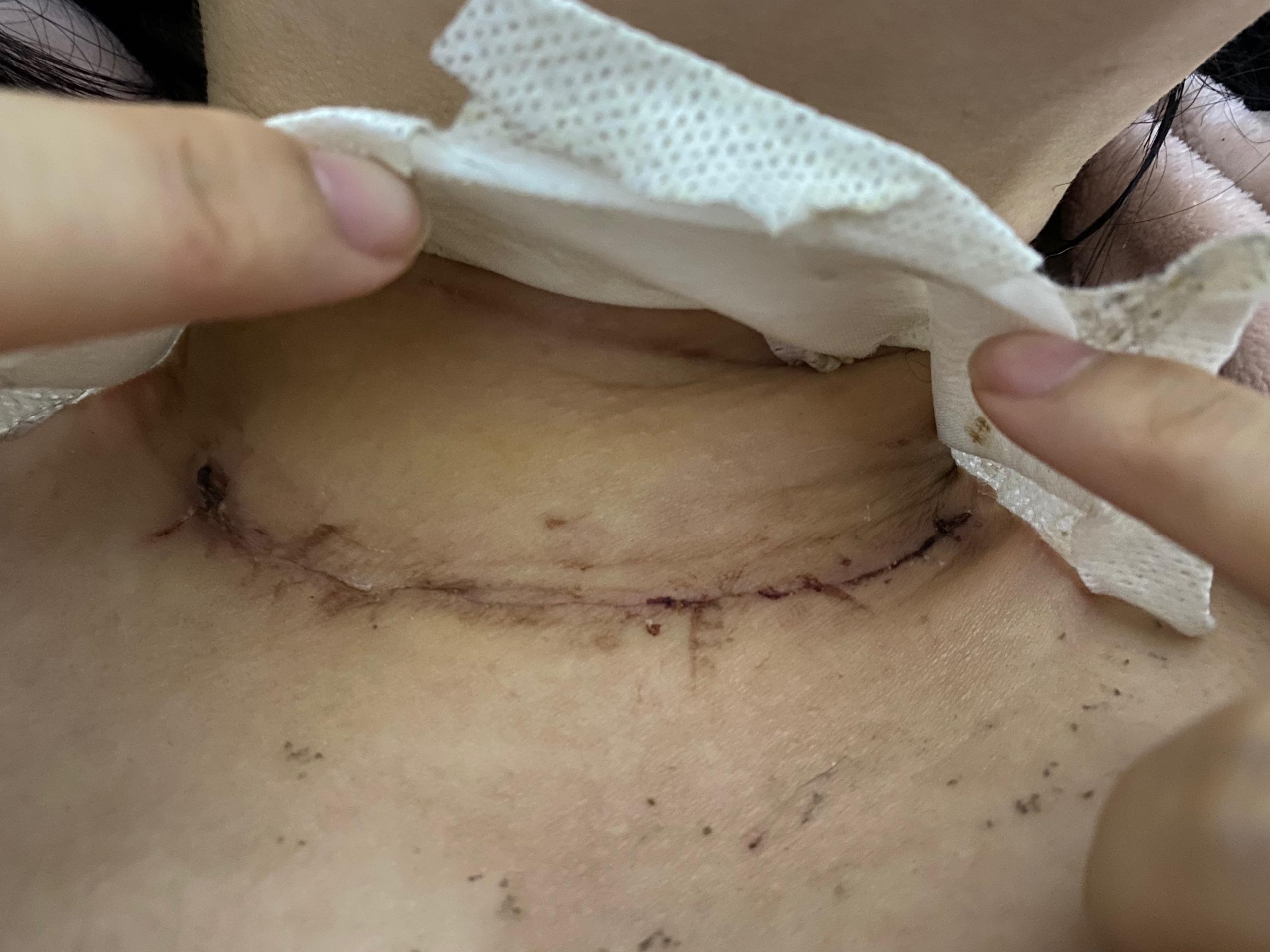 甲状腺手术一年刀疤图图片