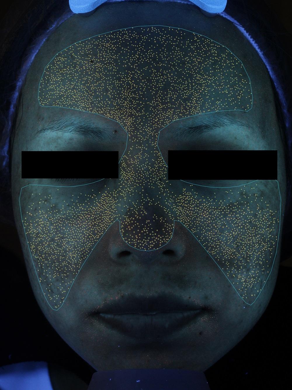 visia镜头下的痤疮丙杆菌没错你的闭口和痘痘底下都是它