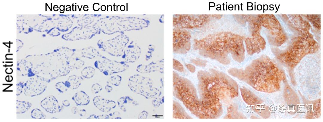 罕見轉移性陰莖鱗癌檢出nectin4高表達維恩妥尤單抗助力臨床緩解