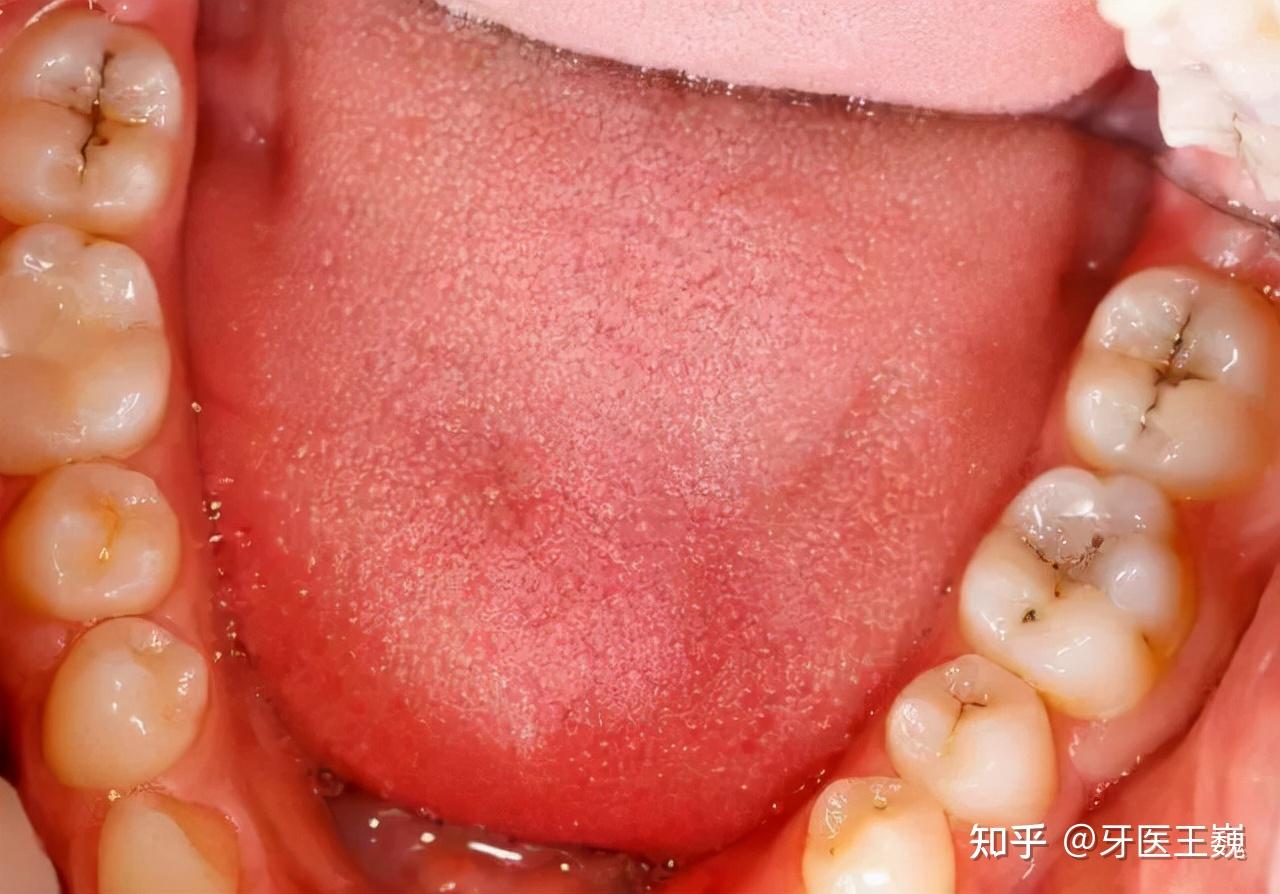波哥日常病例分享（十三）正畸出牙缝做种植牙 - 知乎