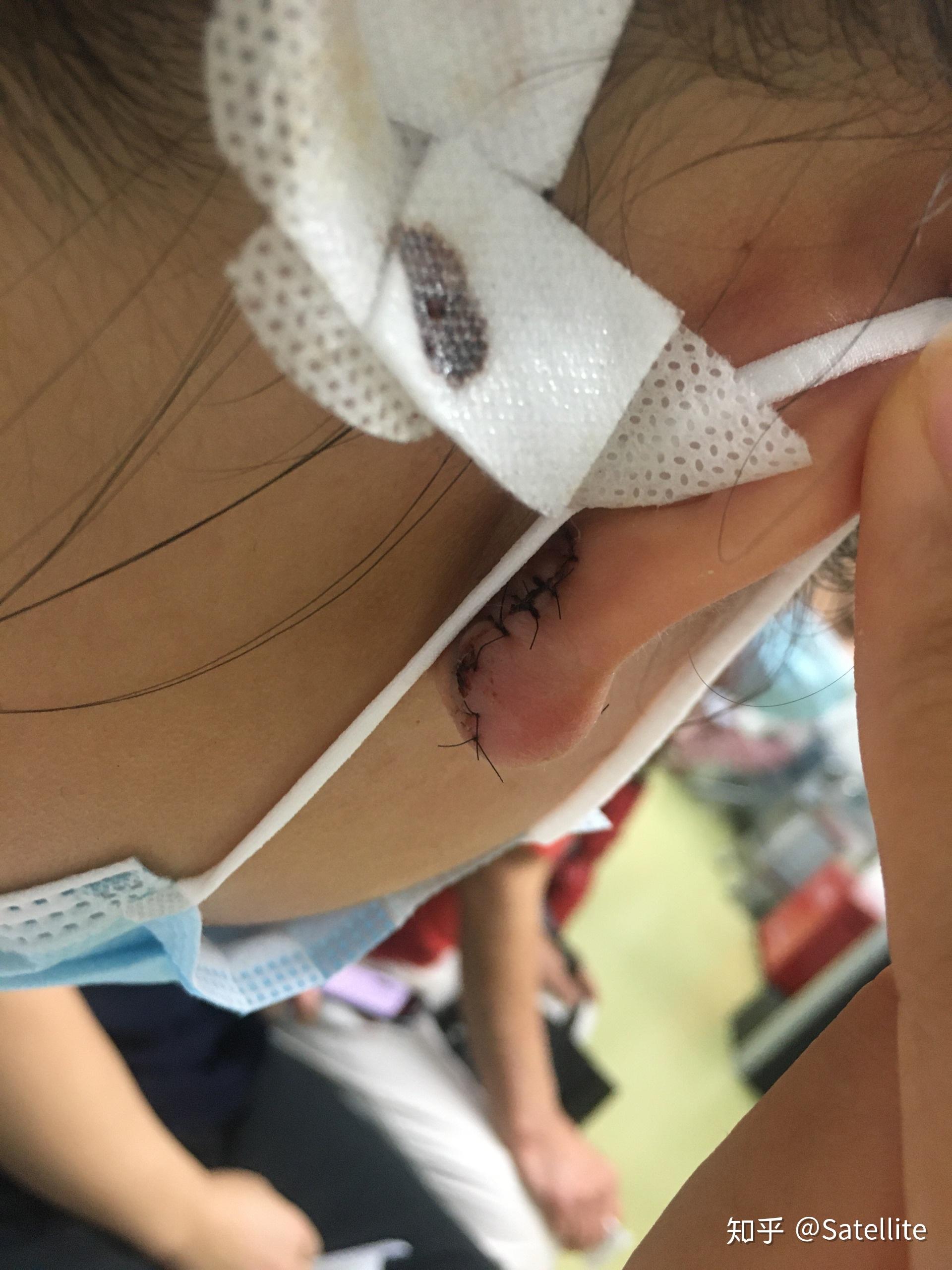 手术不到一个小时,然后医生帮我包扎的伤口手术前的照片2020年4月17日