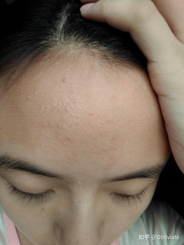 求告知真正有用去闭口痘的办法? - 知乎