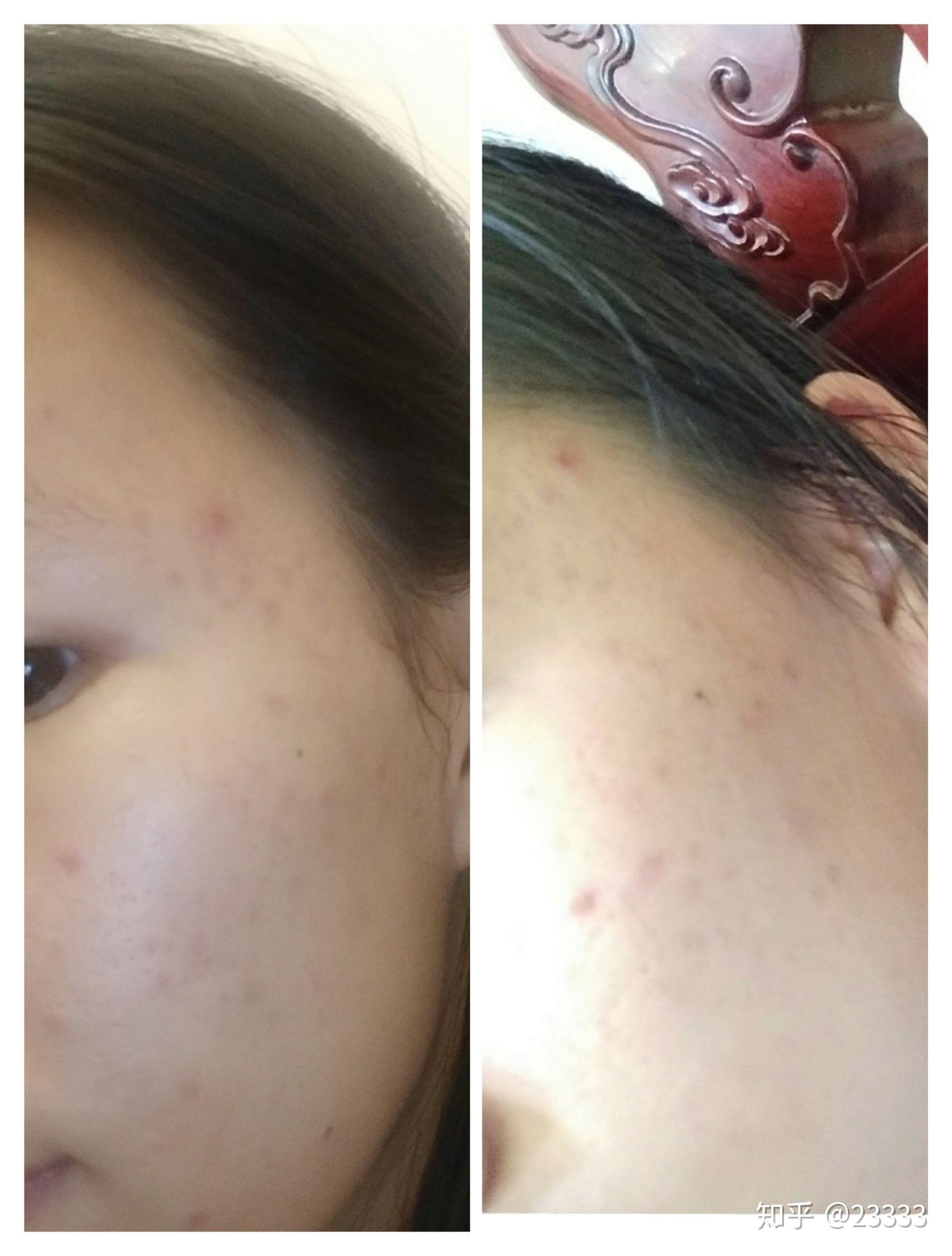一个关于维a酸乳膏的使用体验78 - 知乎