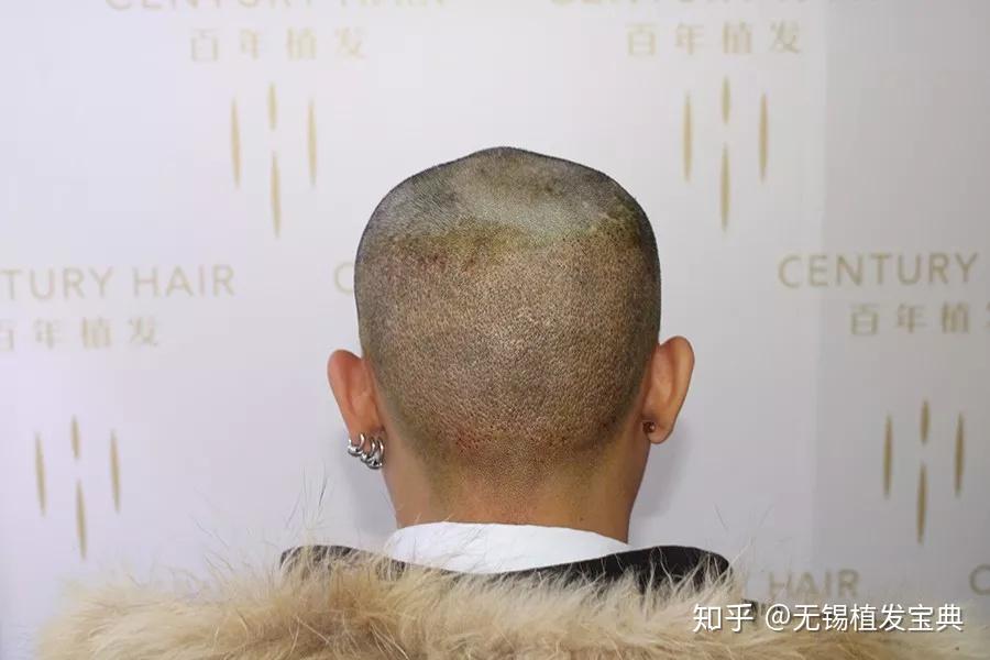 【无锡植发】种植密度如何算?额角种植2500单位彻底摆脱M秃 - 知乎