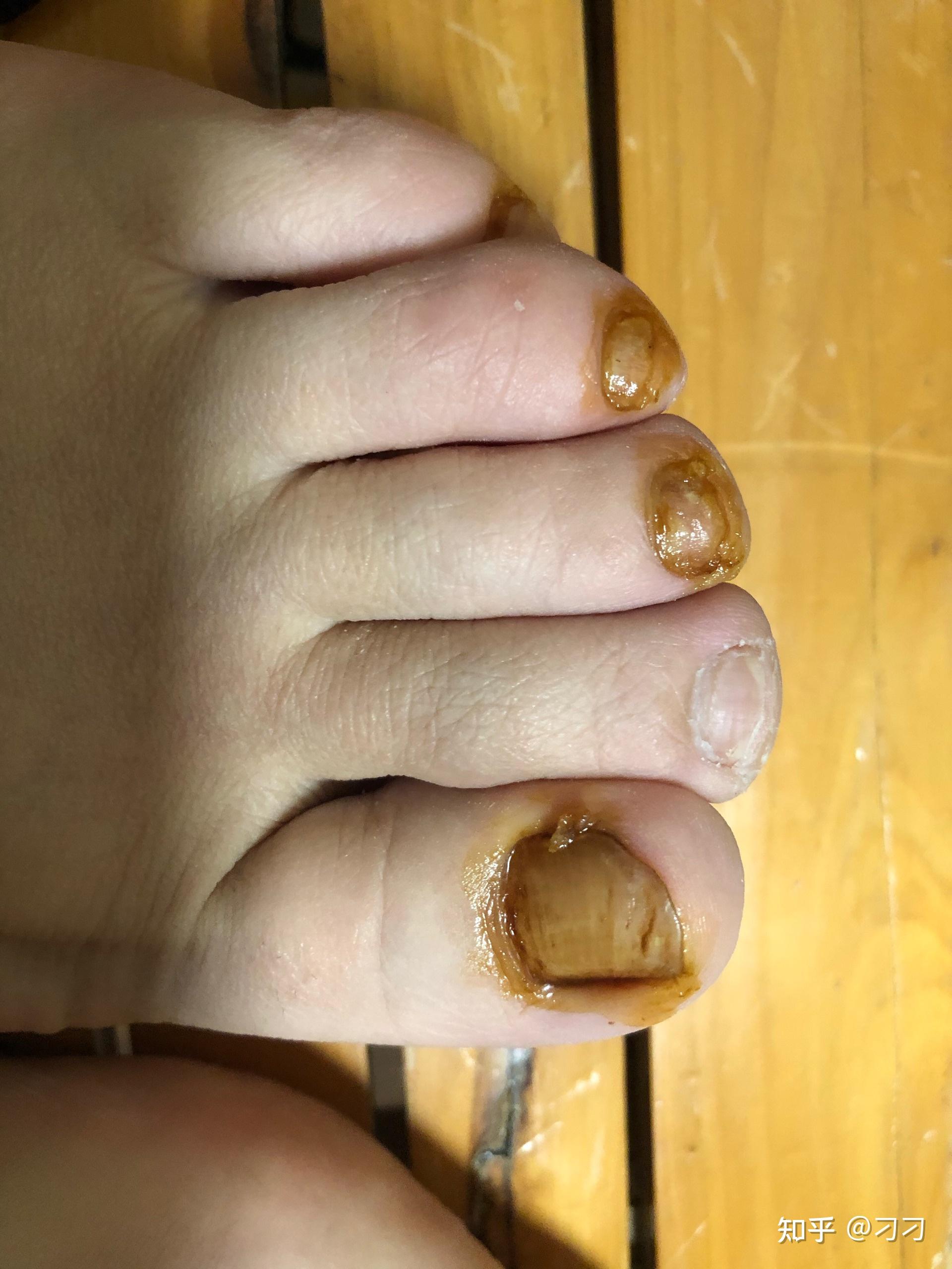 我在试验白醋泡脚治灰指甲,有好转,关键把我的水泡脚气治好了
