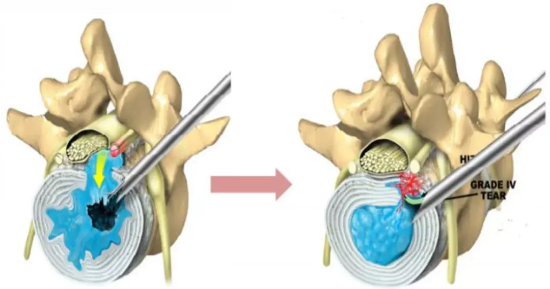 椎间孔镜动画演示图片
