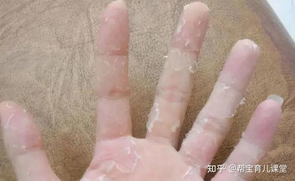 小朋友手脱皮如何应对 知乎