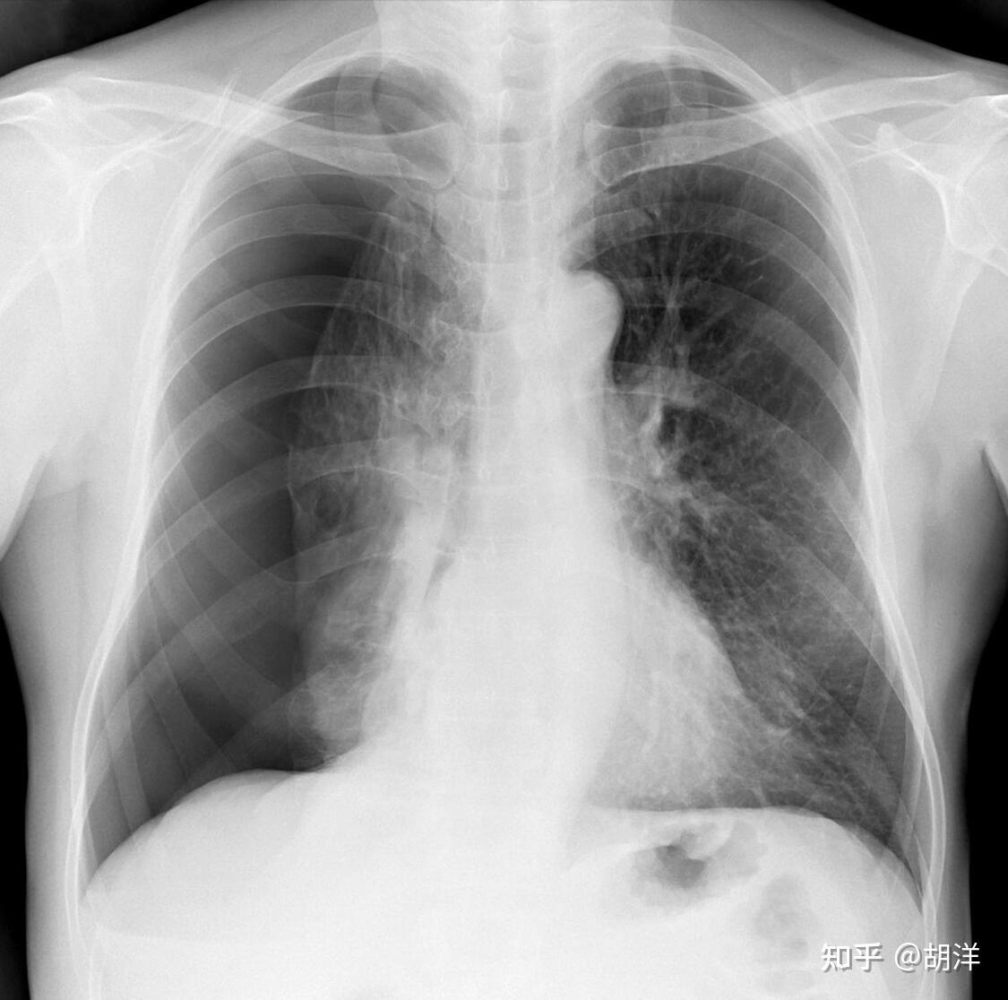 医生，救救我，我肺破裂了！ 知乎