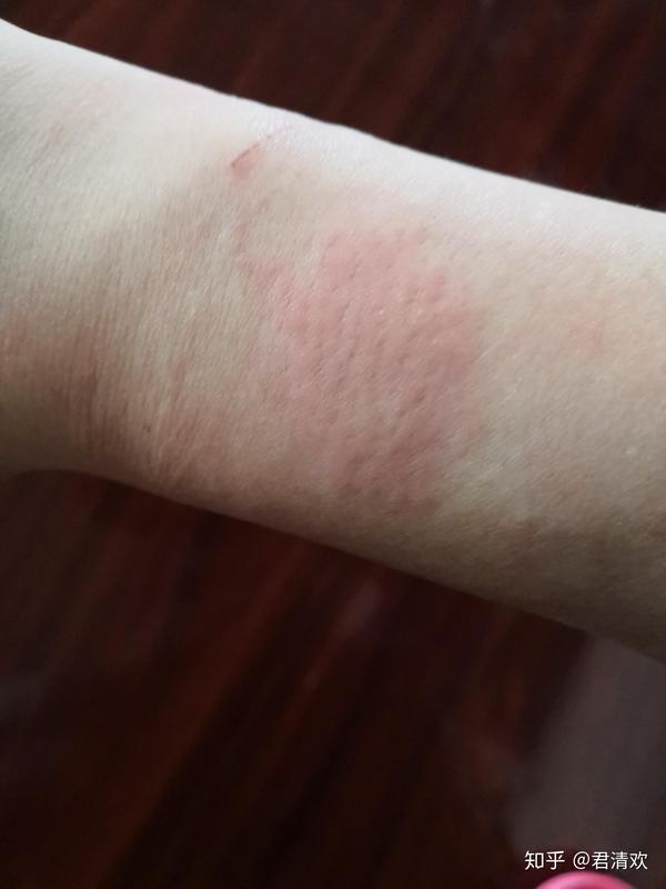 为什么有的人会对创可贴/胶布过敏?过敏原是什么?是过敏吗?