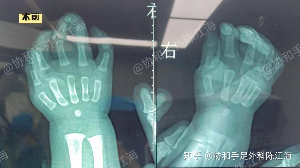 并指免植皮 | 案例 38《三肢并指(趾),情况各异,一次手术全解决》 - 知乎
