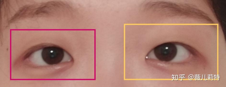 全切双眼皮开内眼角恢复日志不断更ing无疤痕无增生肿胀缓慢恢复中