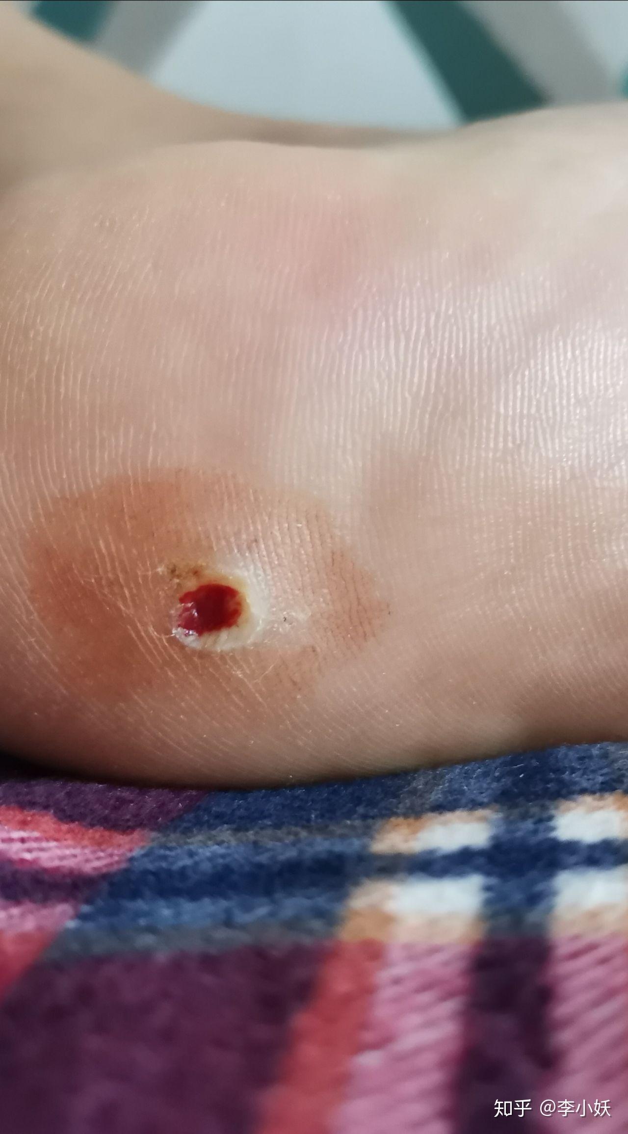 跖疣激光去除经过