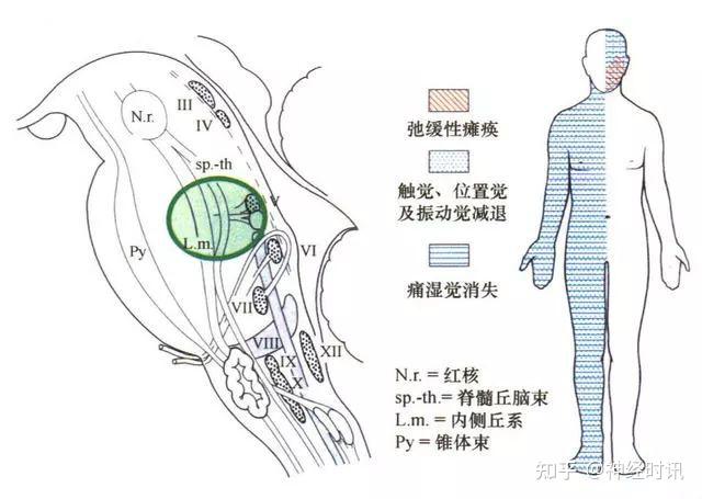 10大常见脑干综合征 - 知乎