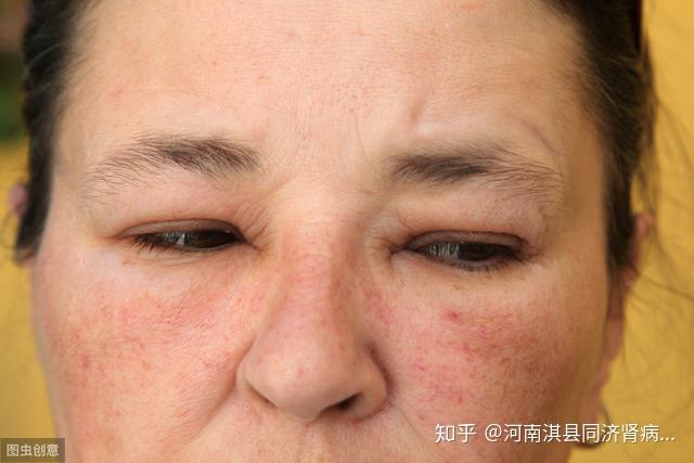 肾炎性水肿:主要是由于肾小球滤过面积减少,排钠能力下降,导致水钠