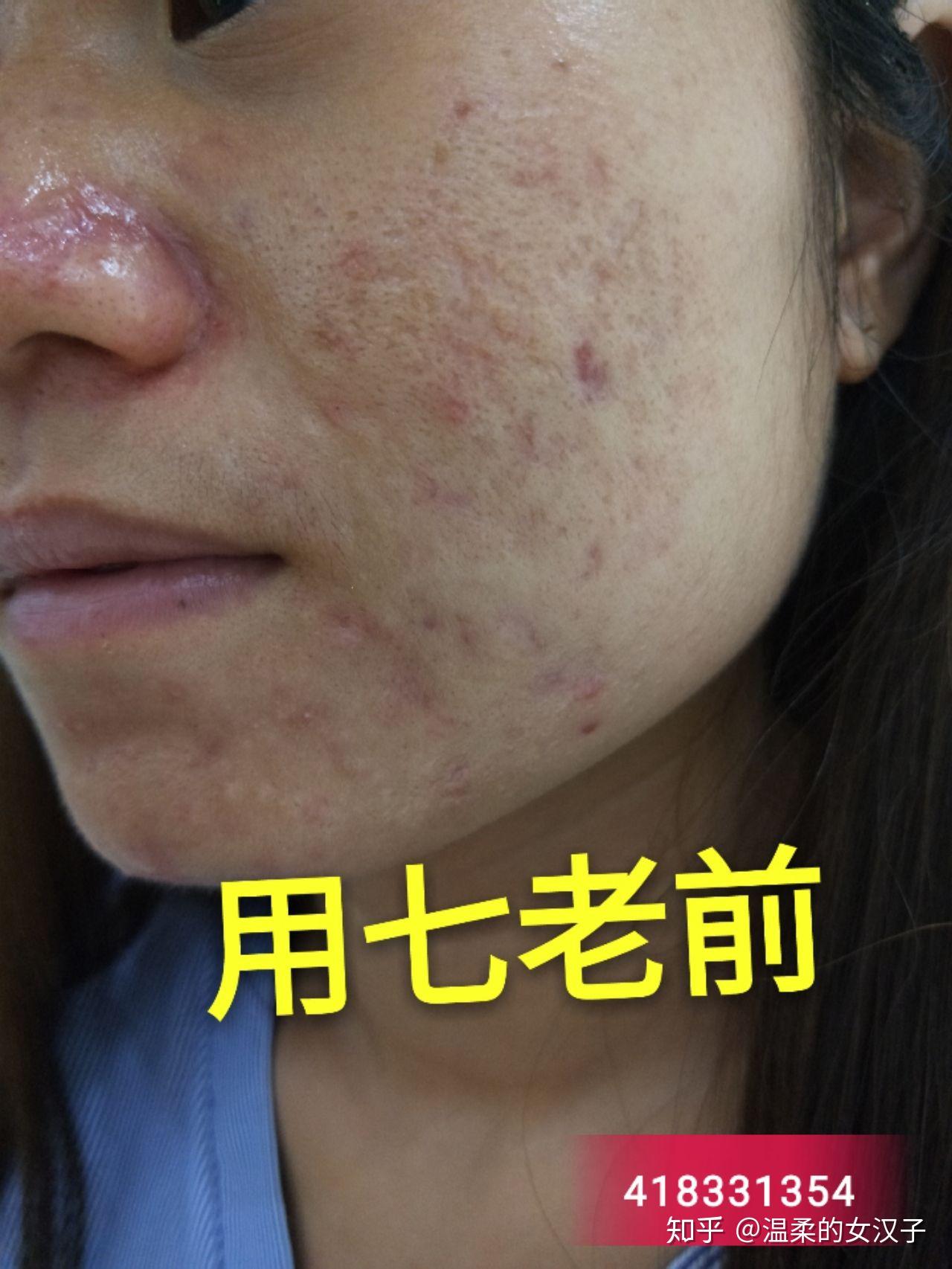 痘痘肌肤千万不要这样弄