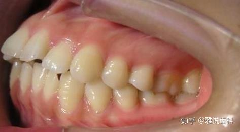 哪些人需要做牙齿矫正