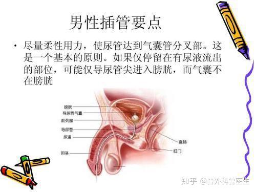 肛门插管排毒图片