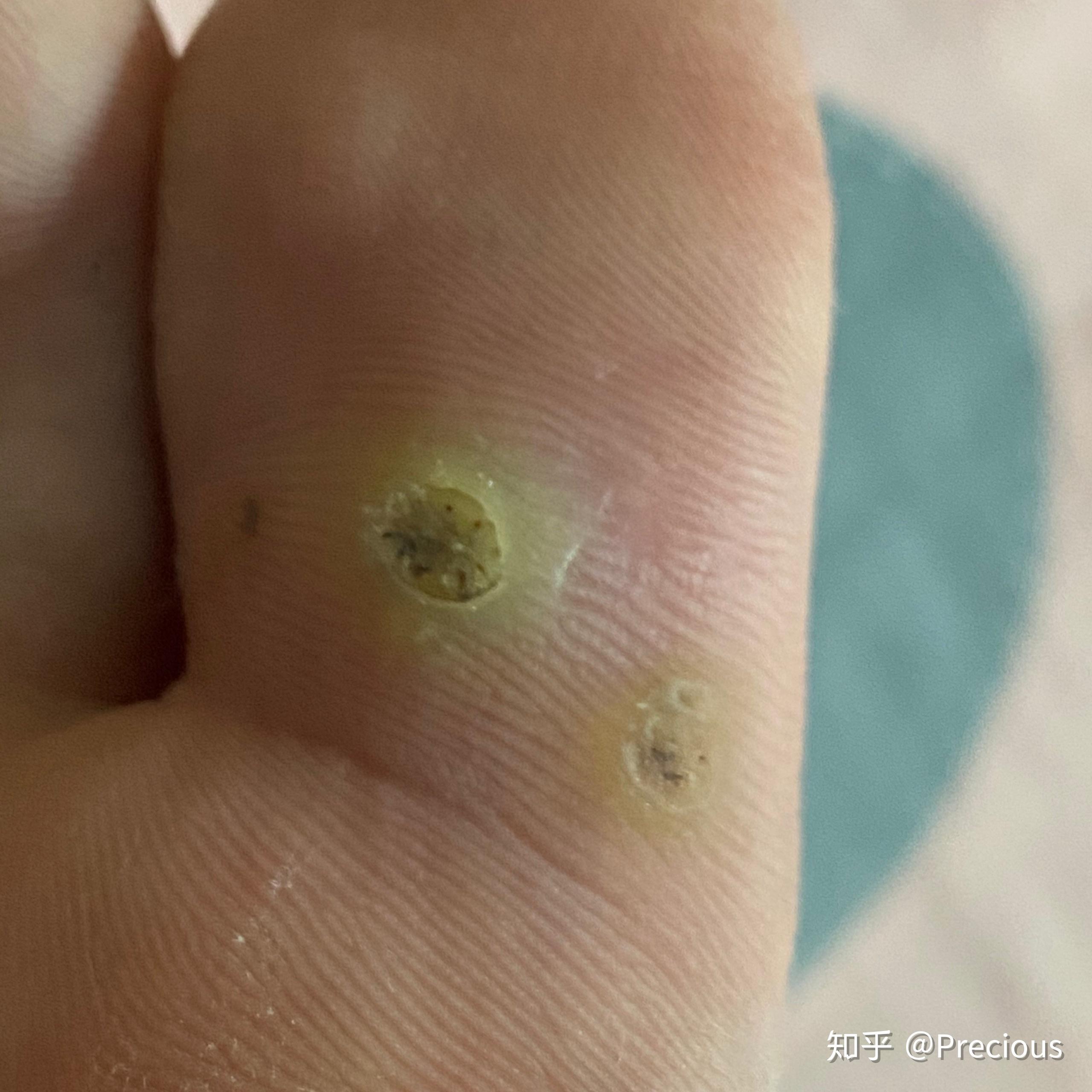 根根分明12月28号凌晨12月30号晚上八点我用指甲刀剪了母疣口一圈的皮