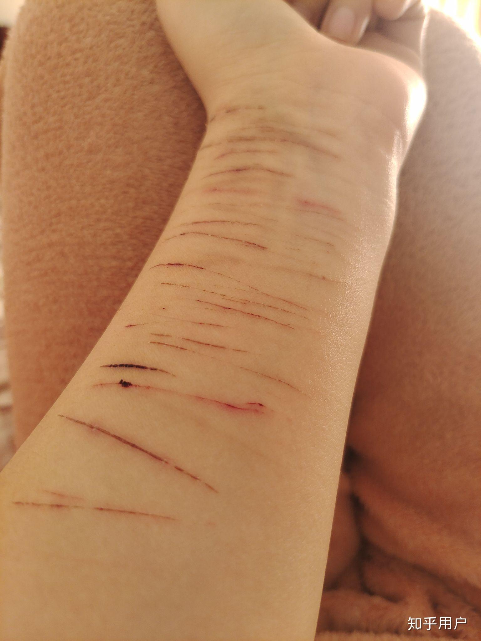 自残的人很恶心吗