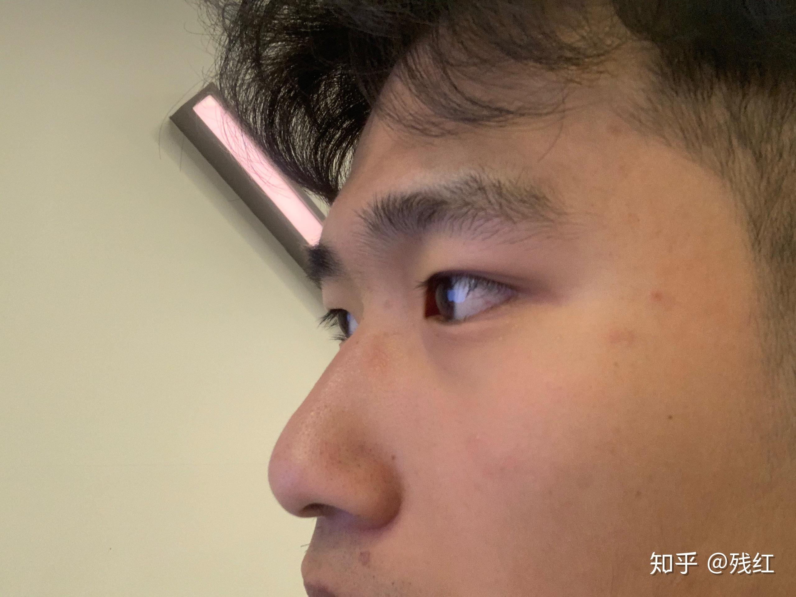 鼻子高但是山根低是什么样