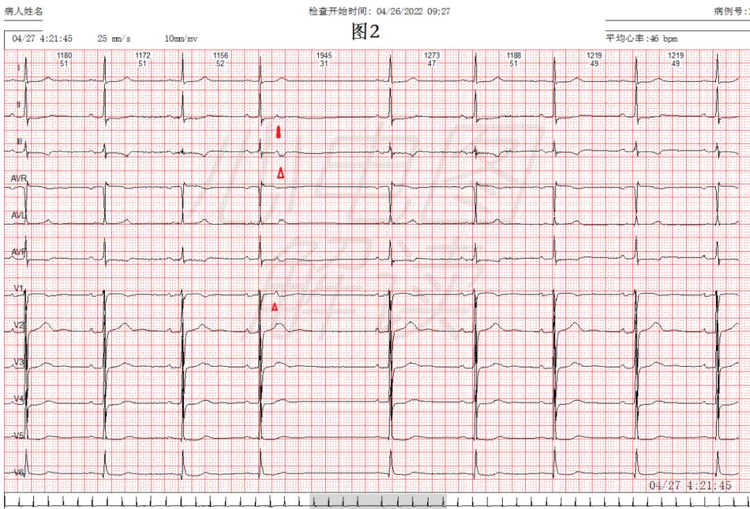 房早未下传心电图图片图片