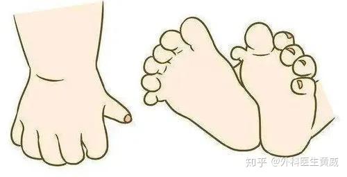 孩子多长了个手指怎么办?多指症如何治疗? - 知乎