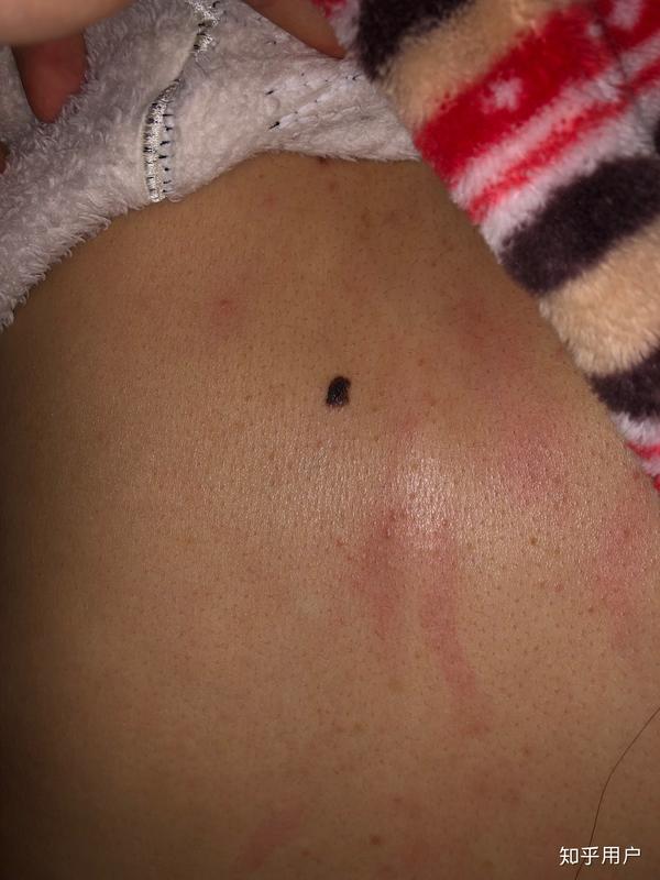 黑痣和黑色素瘤有什么联系?