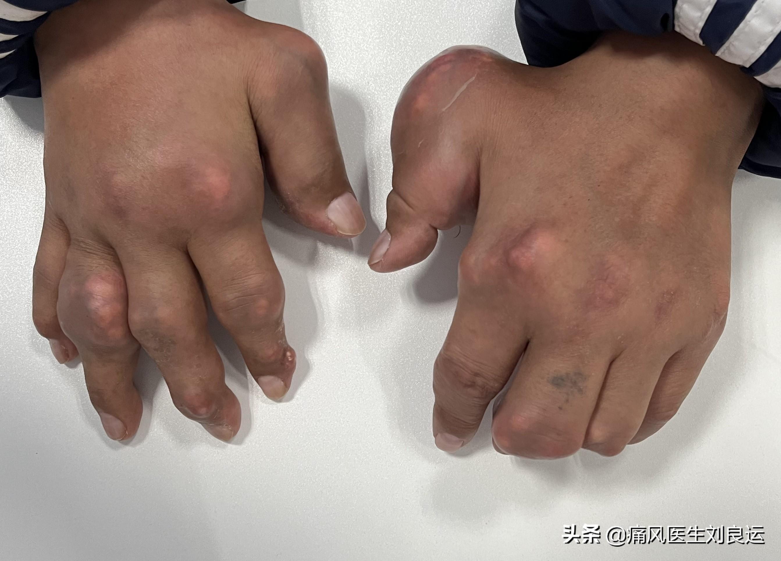 痛风如何避免复发把握治疗目标选择治疗药物躲开发作诱因