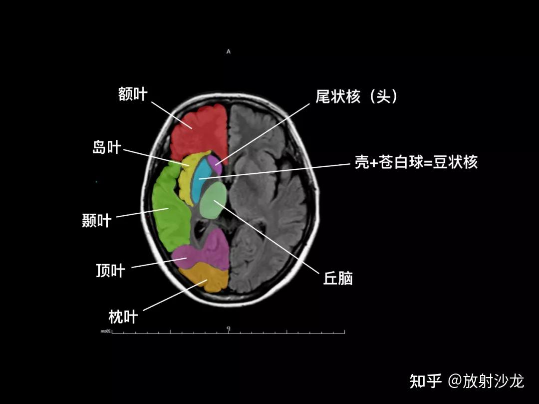 颅脑MR阅片手绘(一)|徐桂兴博士 - 知乎