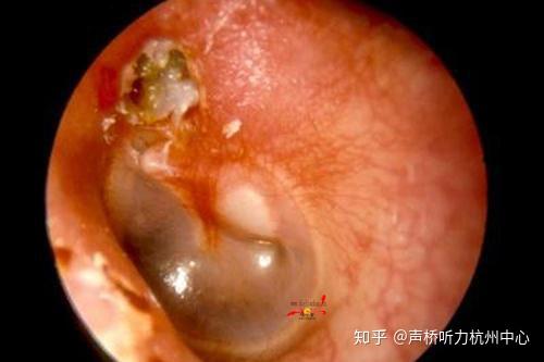 引起鼓膜穿孔的几种原因 知乎