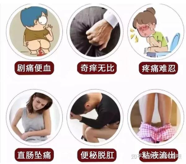 夏季痔疮高发，日常预防措施 - 知乎