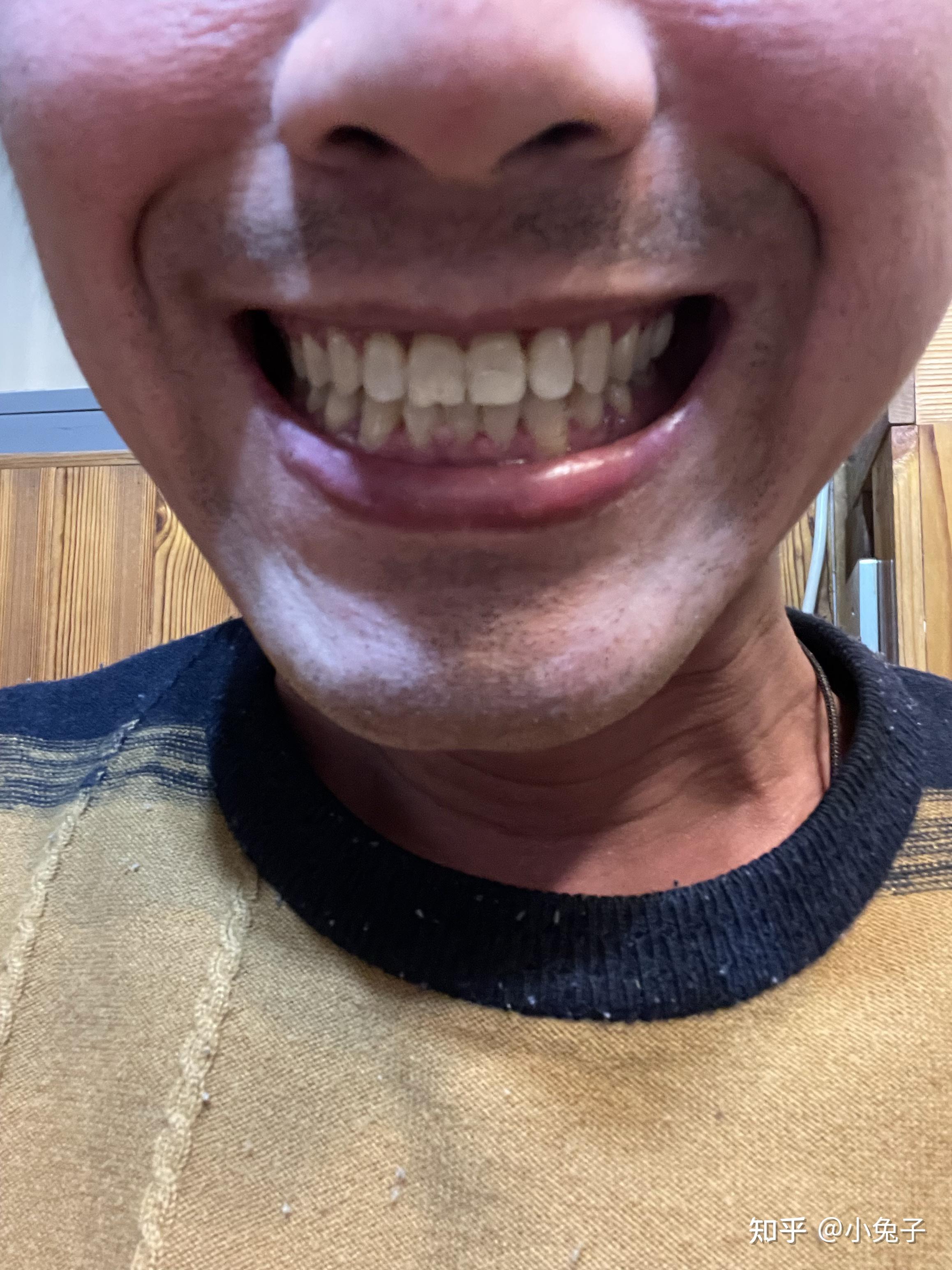 38岁大叔的正畸牙齿矫正路