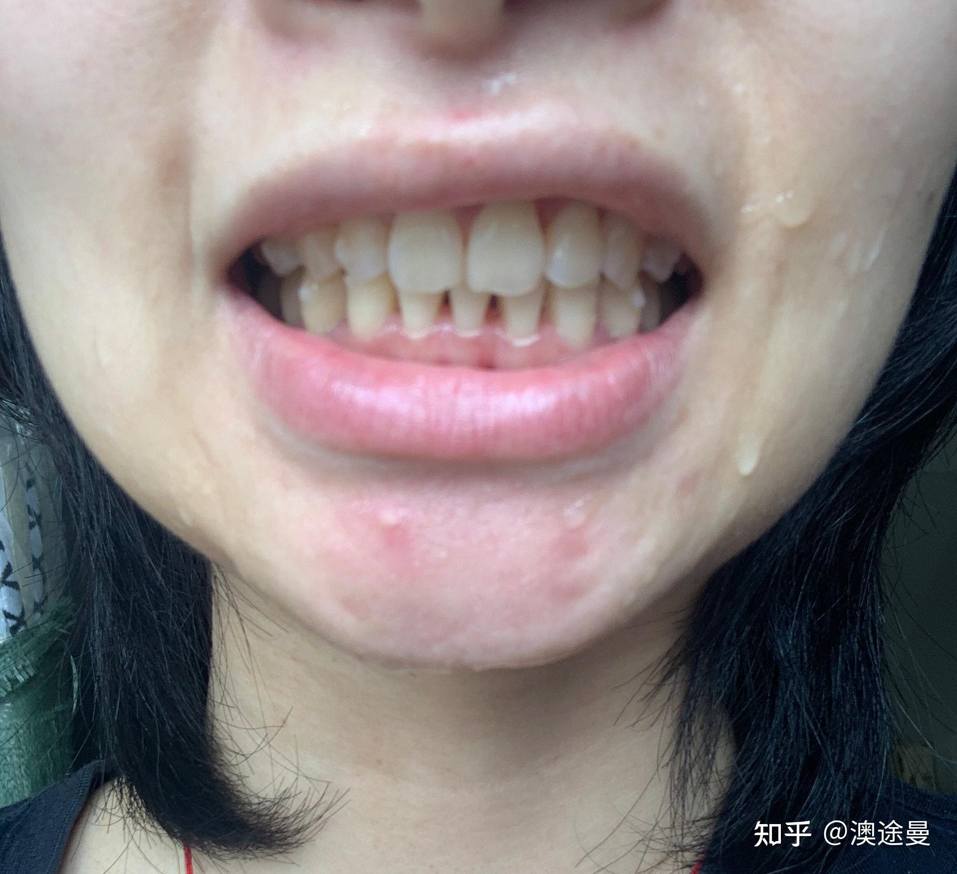 正畸要拔一颗下门牙有盆友拔过么