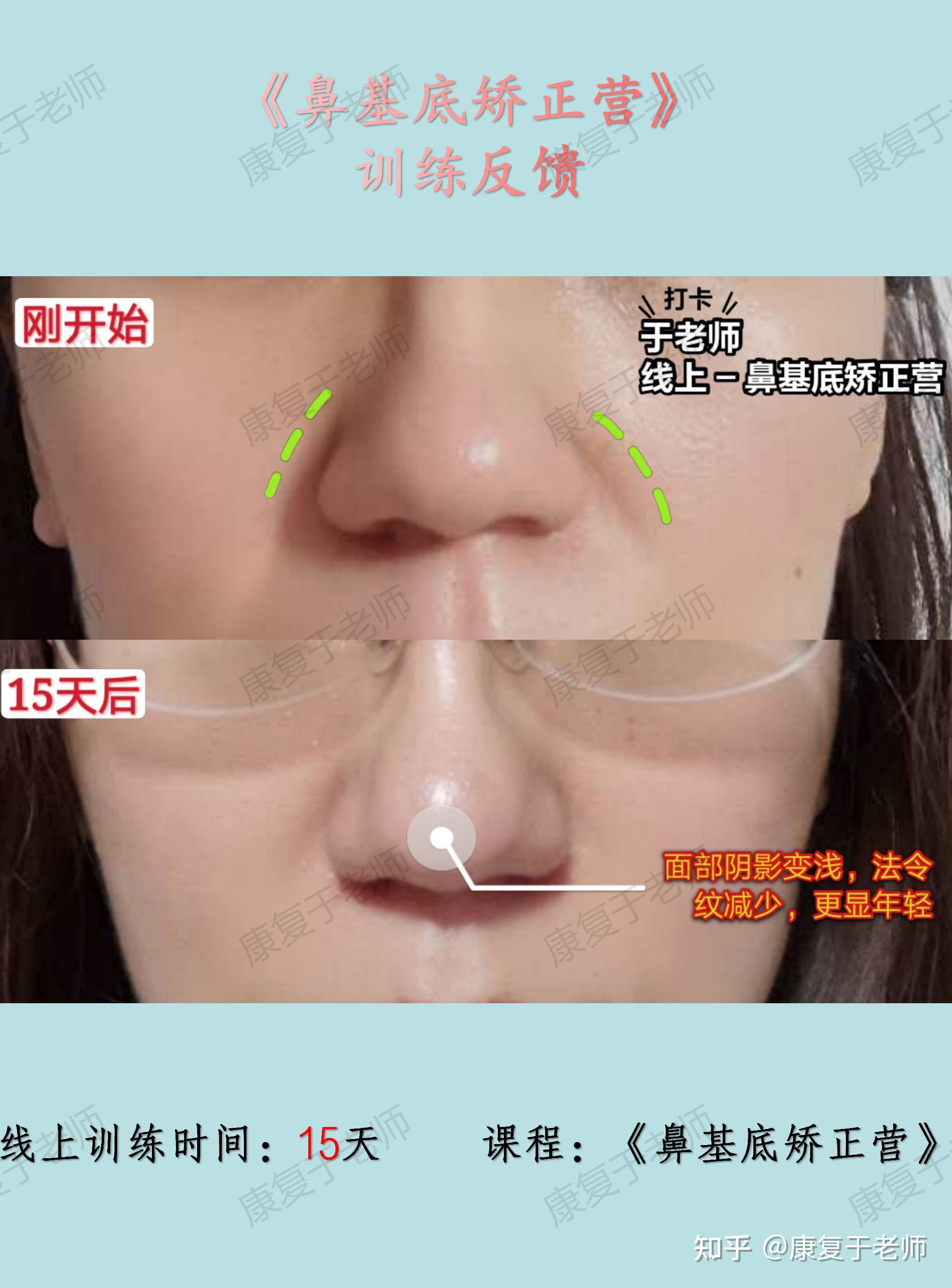 直播预告鼻基底凹陷法令纹深等如何预防和改善