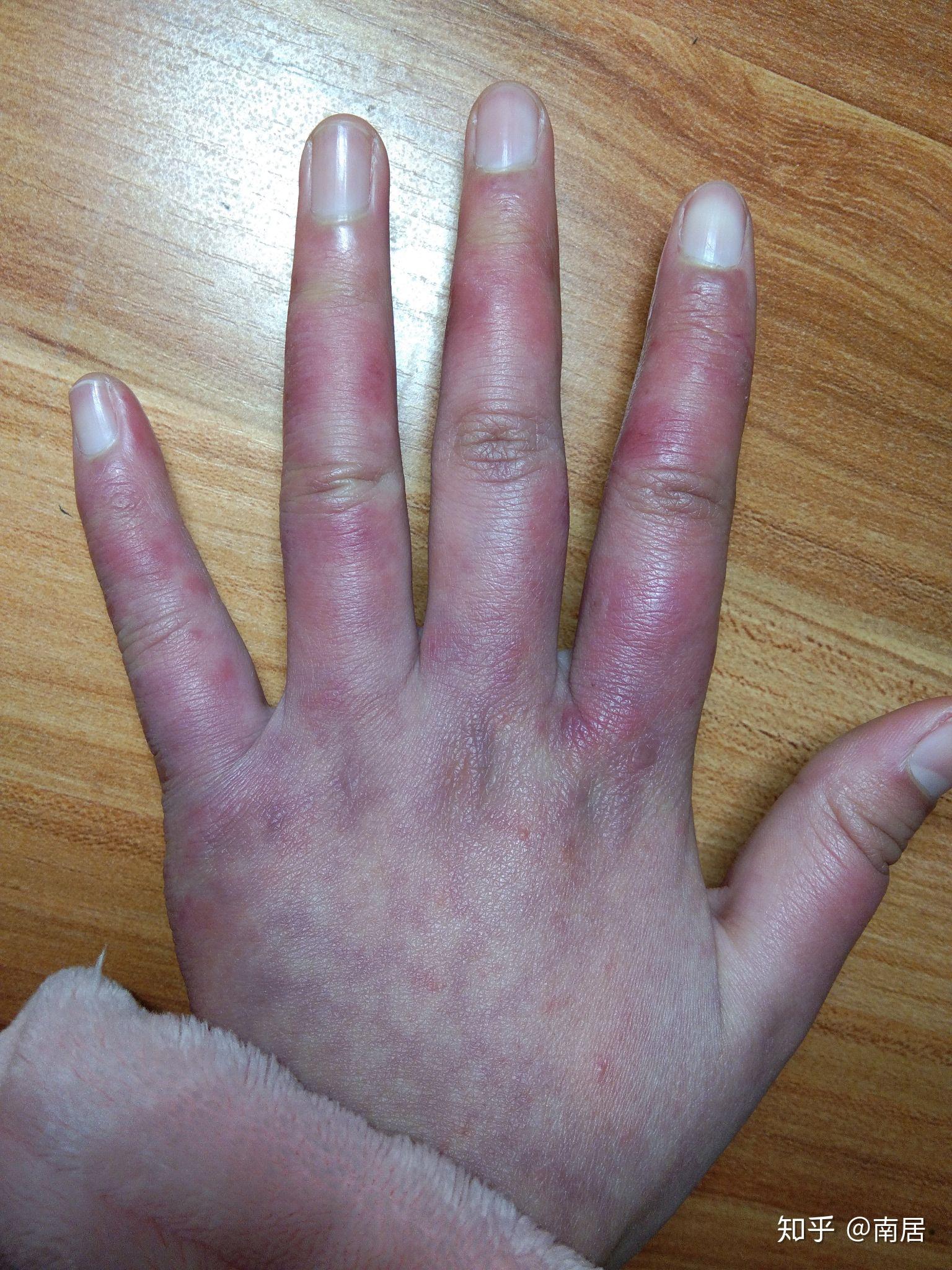冬天长冻疮是一种什么体验