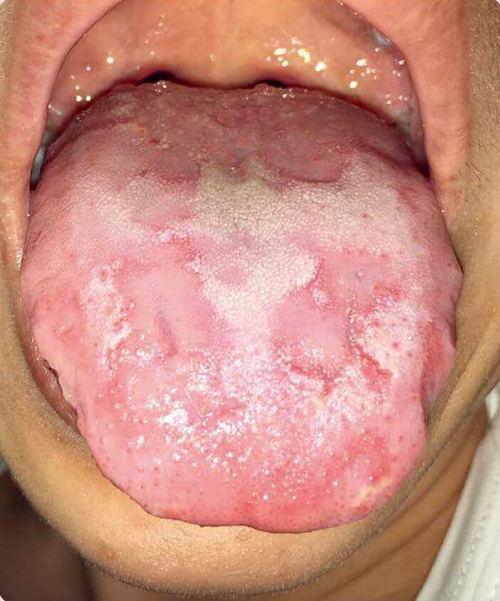 舌头上有齿痕:是脾虚湿气重舌头颜色淡白:脾虚吸收不好气血不足舌苔