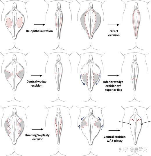16 小时前 小阴唇是位于大阴唇内侧一对较薄的皮肤皱襞,起始于阴蒂