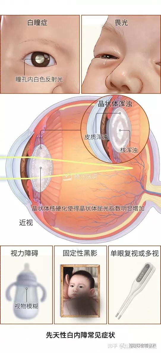 白内障示意图图片