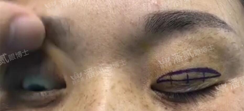 2)提肌手术,即上睑下垂矫正手术