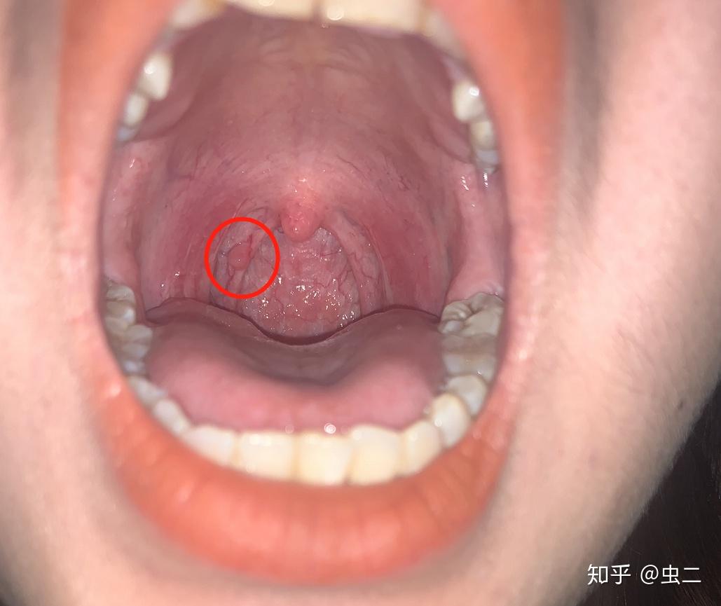 舌乳头状瘤怎么办图片
