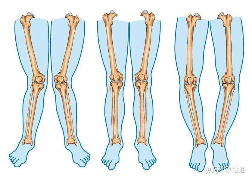 x型腿,o型腿,xo型腿,分别是指什么?