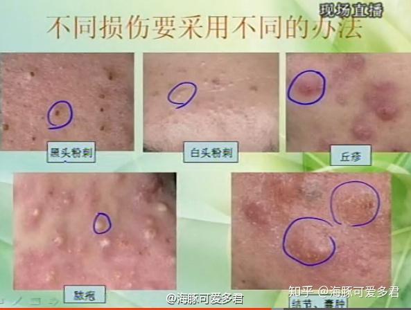 怎么才能不长白头粉刺 v2-8ee3e43c5e6f8c54d1ad375a1ac43181_r.jpg