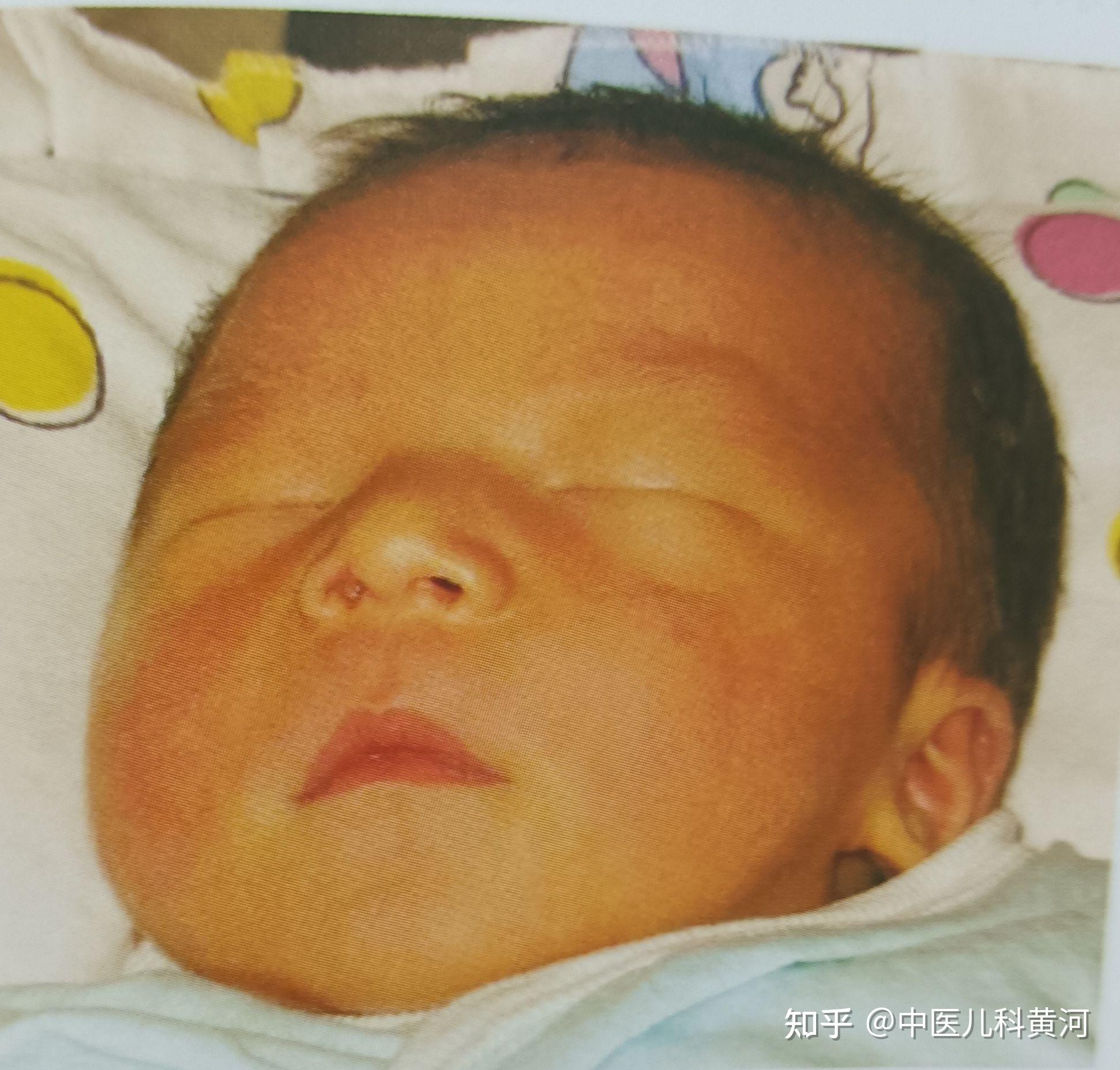 中医儿科黄河医生:什么是新生儿黄疸?如何诊断和治疗?如何调护 - 知乎