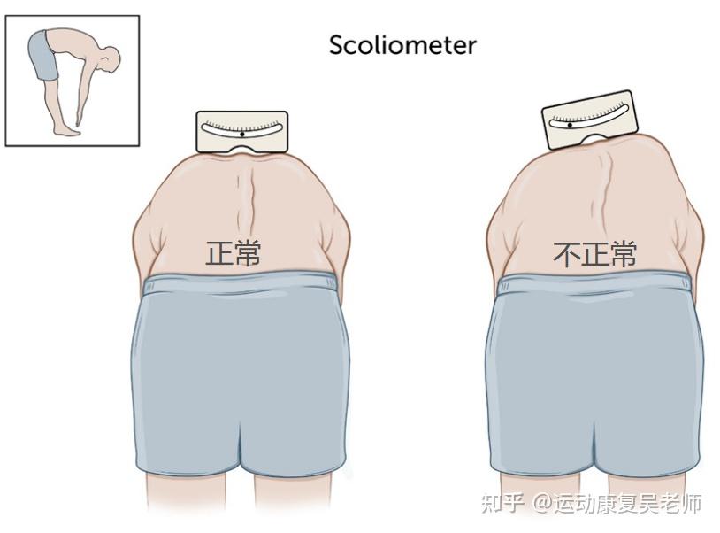 【科普干货】有一种痛叫脊柱侧弯 - 知乎