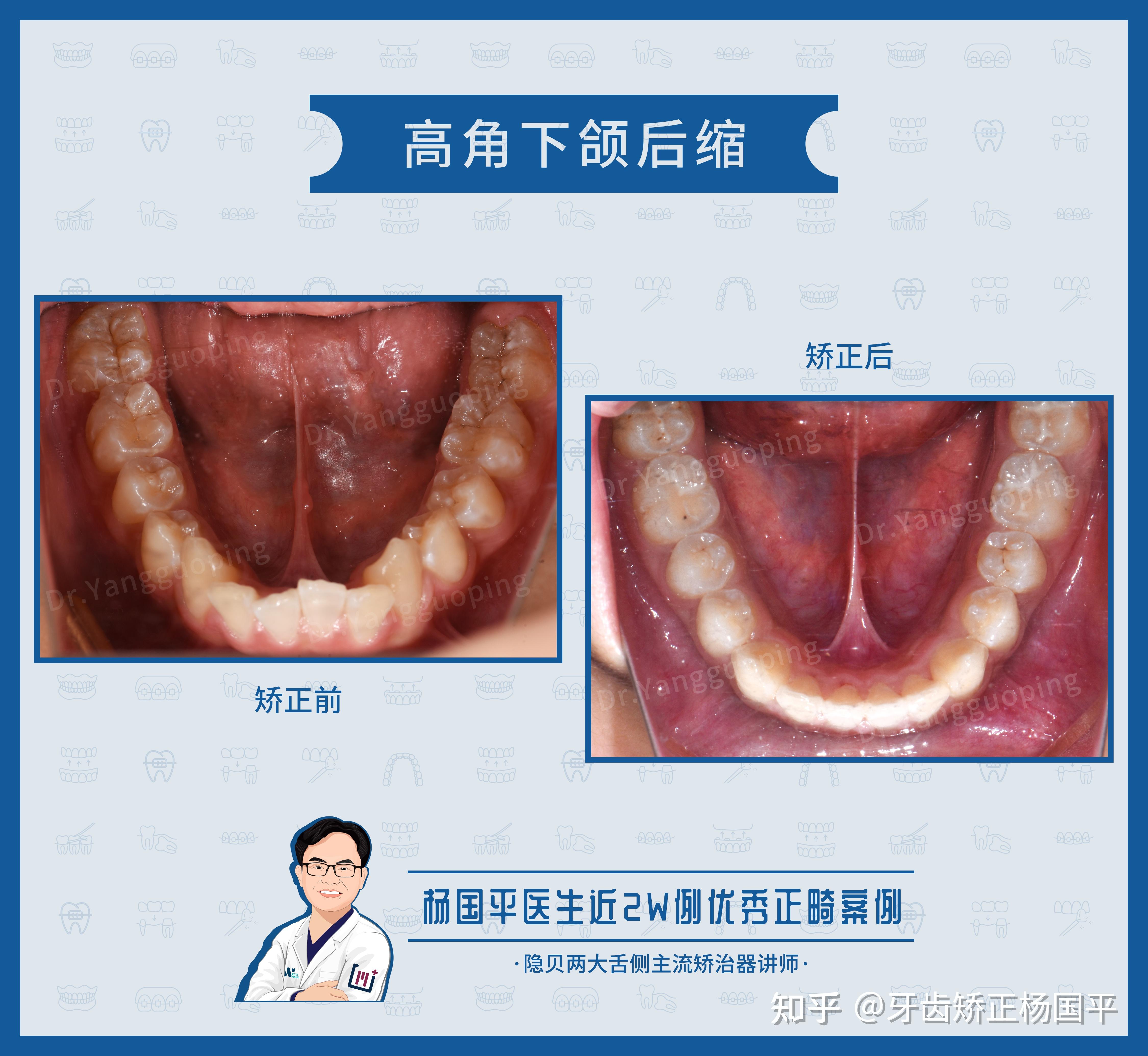 上海牙齿矫正:舌侧矫正案例no633,上下牙列片切解决高角下颌后缩