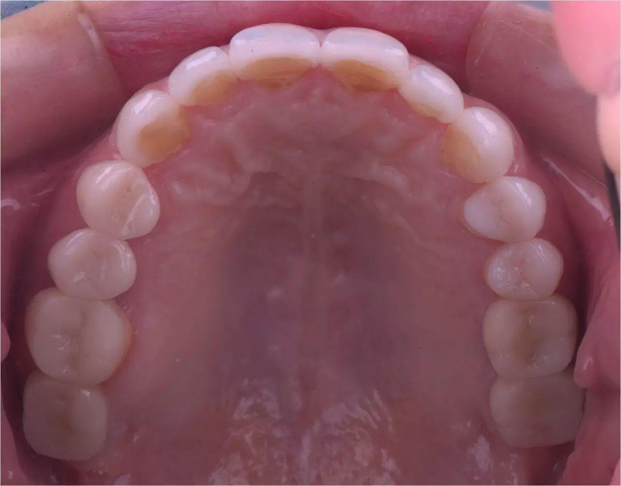 上下牙龈正常是什么样的图片?用一张标准的咬合图告诉你-欣美整形网