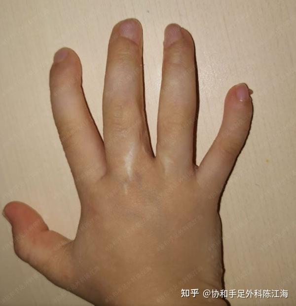 并指免植皮 | 案例5 孩子右手中、环指并指,家长术后谨遵医嘱,效果很理想 - 知乎
