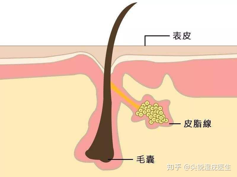 皮脂腺異位症多在青春期發生,發生的部位不只侷限於口腔黏膜,可以發生