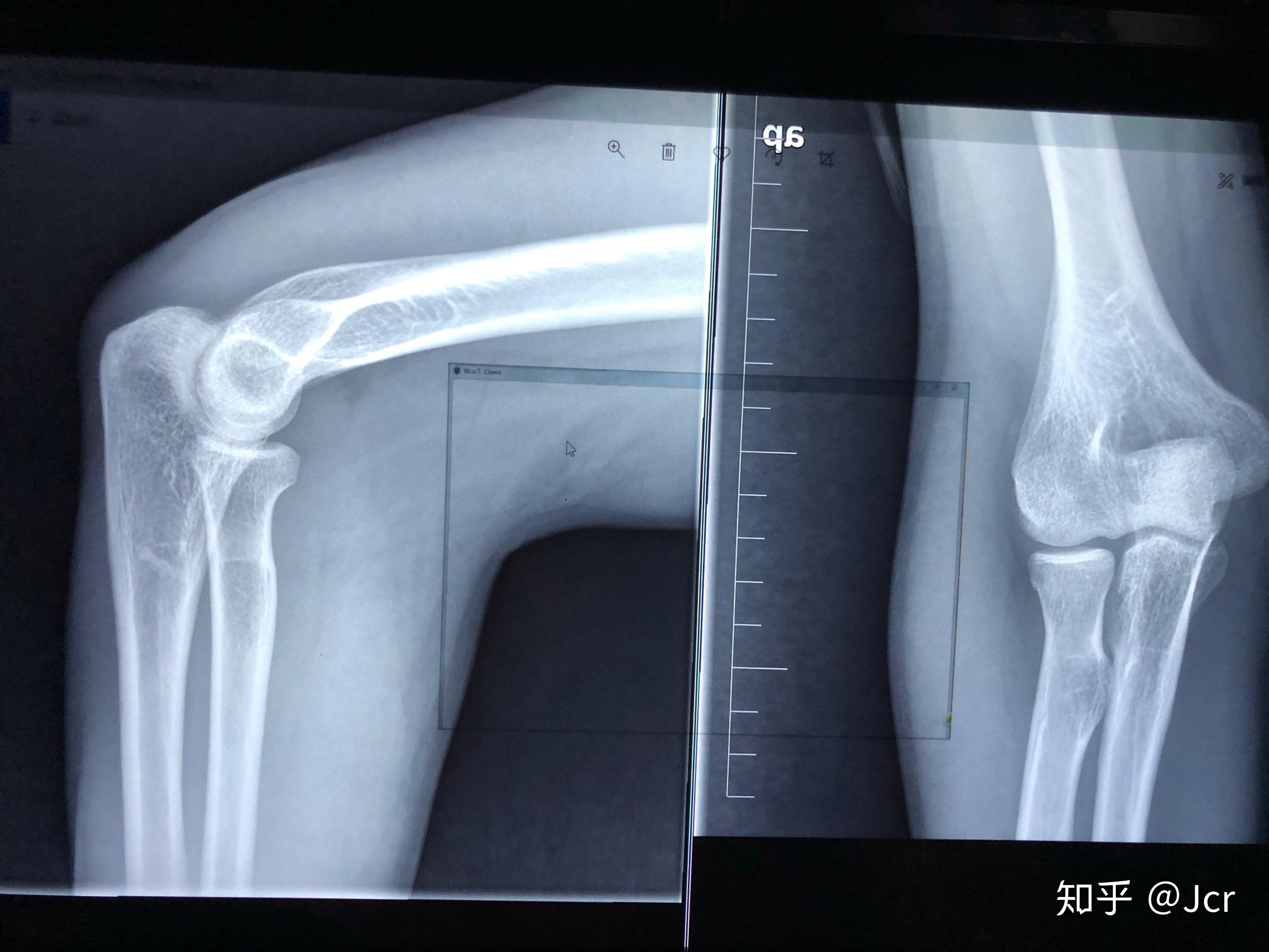 肘关节不能完全伸直弯曲,然后去医院检查说是左桡骨小骨骨折,但是片子