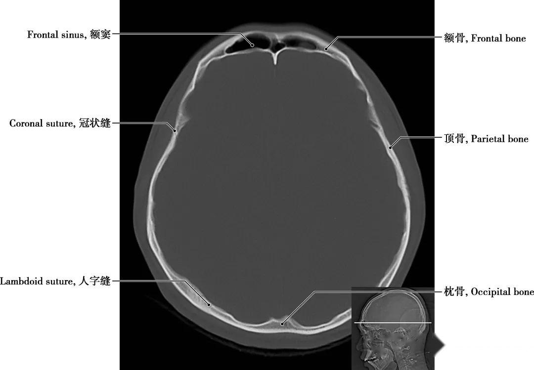 详细标注版!颅脑CT正常解剖图谱 - 知乎